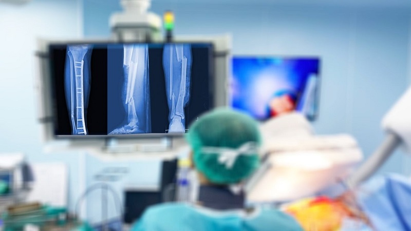 Médicos ortopedistas do HMC vão parar por falta de Órteses, Próteses, Materiais Especiais e salários atrasados