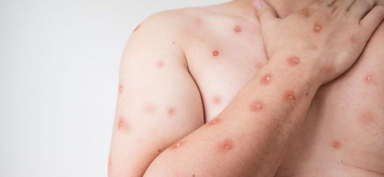 ORIENTAÇÃO: SES alerta para monitoramento de casos de Mpox em MT após avanço de variante em Rondônia