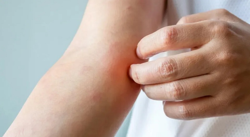 Surto de fungo sexual “altamente contagioso” preocupa Europa